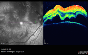 OCT Δεξιού οφθαλμού, με αποκόλληση αμφιβληστροειδή (δεξιά) και πτυχές στην ωχρά (αριστερά)