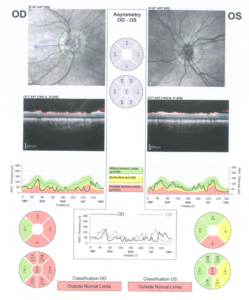 Λέπτυνση της στοιβάδας των περιθηλαίων οπτικών ινών, κυρίως στο δεξιό οπτικό νεύρο λόγω ντρουζεν (drusen)