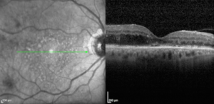 Διαβητική ωχροπάθεια με ήπιο οίδημα της ωχράς κηλίδας, όπως φαίνεται στην οπτική τομογραφία συνοχής (OCT) στην δεξιά πλευρά της εικόνας.