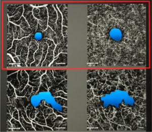 OCT Αγγειογραφία στο διαβήτη, όπου φαίνεται η ανάγγειος ζώνη (μπλέ χρώμα) του διαβητικού ασθενούς (κάτω) σε σύγκριση με τη φυσιολογική (επάνω). Παρατηρείστε την παραμόρφωση στις κάτω εικόνες εν συγρίσει προς τις ομαλές οβάλ στις πάνω εικόνες