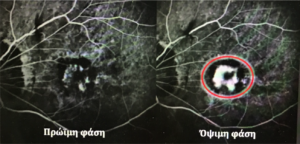 Μυωπική νεοαγγείωση πριν και μετά τη θεραπεία με ενδοϋαλοειδικές ενέσεις αντιαγγειογενετικού παράγοντα (anti-VEGF). Παρατηρείστε την υποχώρηση της βλάβης εντός του κόκκινού κύκλου στην αριστερή εικόνα.