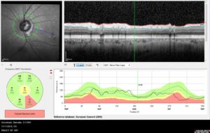 Διάγνωση γλαυκώματος με OCT RNFL (οπτικών ινών). Παρατηρείστε την κατώτερη λέπτυνση που απεικονίζεται με κόκκινο χρώμα (κάτω αριστερά στον έγχωμο κύκλο).