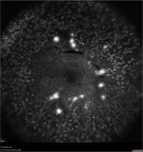 Διαβητική νεοαγγείωση, όπως απεικονίζεται με πανοραμική ψηφιακή φλουροαγγειογραφία. Δείτε τις λευκές κηλίδες, σαν ωιφάδες απο βαμβάκι. Απεικονίζεται όλη η περιφέρεια του βυθού, όπου έχει γίνει laser. 