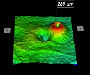 Τρισδιάστατη απεικόνιση του χάρτη πάχους της ωχράς κηλίδας με χρήση 3D OCT, όπου φαίνεται χοριοειδική νεοαγγείωση με μορφή κρατήρα ηφαιστείου σε ασθενή με ηλικιακή εκφύλιση ωχράς.