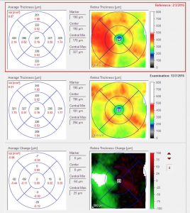 Παρακολούθηση διαβητικού οιδήματος ωχράς κηλίδας με χάρτη πάχους OCT. Τα κοκκινα χρώματα αντιπροσωπεύουν αυξημένο πάχος (οίδημα ωχράς κηλίδας). Παρατηρείστε την υποχώρηση στην δεύτερη φωτογραφία μετά απο θεραπεία.