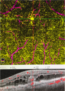 Εικόνα νεοαγγείωσης στον αμφιβληστροειδή σε ασθενή με RAP, όπως απεικονίζεται με OCT αγγειογραφία. 