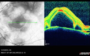 OCT αριστερού οφθαλμού με μεγάλη αποκόλληση ωχράς