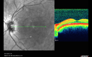 OCT OS post-treatment