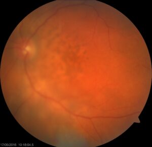 FUNDUS IMAGE LYMPHOMA