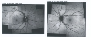 Αυτοφθορισμός και των δυο οπτικών νεύρων, όπου φαίνεται η παρουσία των ντρουζεν (drusen) κυρίως στο δεξί μάτι