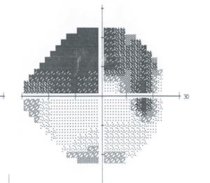 Εκσεσημασμένα σκοτώματα στο οπτικό πεδίο του δεξιού οφθαλμού λόγω πίεσης των οπτικών ινών απο ντρουζεν (drusen) οπτικου νευρου.
