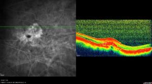 Εικόνα φλουροαγγειογραφίας και OCT ασθενούς με μυωπική ωχροπάθεια και χοριοειδική νεοαγγείωση. Διακρίνεται η διαρροή του σκιαγραφικού στην αγγειογραφία απο τα παθολογικά αγγεία της μεμβράνης.