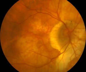 Myopic fundus