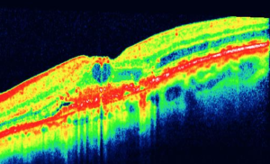 Εκφύλιση ωχράς κηλίδας υγρού τύπου με κύστη κεντρικά στον αμφιβληστροειδή, όπως αυτή απεικονίζεται με OCT. Οι περιπτώσεις αυτές έχουν χαμηλή όραση.