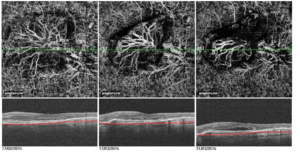 Θεραπεία στην εκφύλιση ωχράς κηλίδας με ενδοφθάλμιες ενέσεις και παρακολούθηση του αποτελέσματος με OCT αγγειογραφία. Παρακολουθήστε στο επάνω μέρος την υποχώρηση της χοριοειδικής νεοαγγειακής μεμβράνης μετά τη θεραπεία.