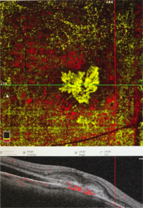Μυωπική νεοαγγείωση, όπως απεικονίζεται με τη νέα OCT-Αγγειογραφία χωρίς σκιαγραφικό. Ο θύσανος των παθολογικών νεοαγγείων απεικονίζεται εδώ με κίτρινο χρώμα.