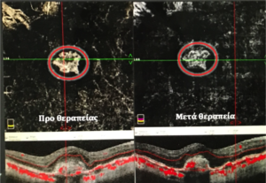 Μυωπική νεοαγγείωση, όπως απεικονίζεται με OCT-Αγγειογραφία (χωρίς σκιαγραφικό), πριν και μετά τη θερπαεία με αντιαγγειογενετικούς παράγοντες (anti-VEGF). Παρατηρείστε την υποστροφή της βλάβης εντός του κόκκινου κύκλου στην αριστερή εικόνα.