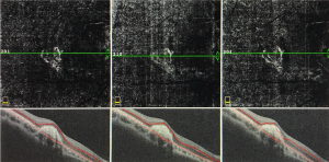 Εικόνα παρακολούθησης με angio-OCT σε ασθενή με ραγοειδίτιδα με χοριοειδική νεοαγγείωση. 