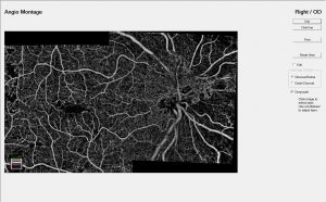 Εικόνα μοντάζ αγγειογραφίας χωρίς σκιαγραφικό, όπου διακρίνεται η διαβητική νεοαγγείωση του οπτικού νεύρου και ισχαιμικές περιοχές στα δεξιά της εικόνας (μαύρες).