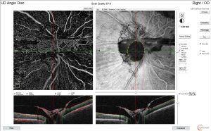 Διαβητική νεοαγγείωση οπτικού νεύρου, η ίδια περίπτωση με την διπλανή εικόνα με Angio-OCT (χωρίς σκιαγραφικό).