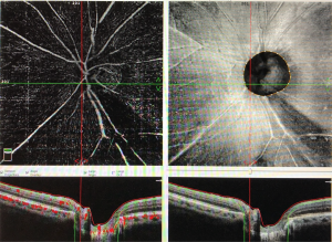 Απεικόνιση γλαυκώματος με χρήση αγγειογραφίας χωρίς σκιαγραφικό (Angio-OCT), όπου διακρίνεται η σφηνοειδής μαύρη περιοχή που ξεκινάει απο το οπτικό νέυρο και αντιπροσωπεύει έλλειμμα των οπτικών ινών. 