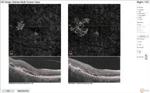 Angio OCT, όπου φαίνεται η απεικόνιση χοριοειδικής νεοαγγείωσης σε εκφύλιση ωχράς κηλίδας σε 2 διαδοχικές επισκέψεις. ΠΑρατηρείστε, οτι ενώ στην κάτω στήλη το υγρό στην OCT δεν έχει αυξηθεί αριστερά συγκριτικά με την δεξιά εικόνα, στην επάνω στήλη υπάρχει μεγάλη αύξηση της νεοαγγειακής μεμβράνης δεξιά. Ο ασθενής αυτός χρειάζεται επανάληψη θεραπείας.