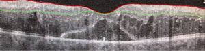 Εικόνα OCT σε διαβητικό οίδημα ωχράς κηλίδας μς ανατομικά χαρακτηριστικά κατάλληλα για ενδοϋαλεοδικό εμφύτευμα κορτιζόνης