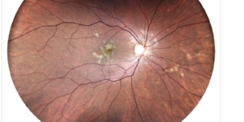 Στικτή έσω χοριοειδίτιδα (PIC)